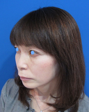 目の下のたるみ、目のくまでお悩みの方、切らずに完璧に解決します。TCB-R法　手術直後　症例写真